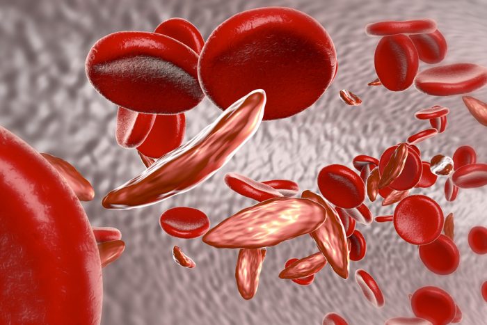 anemia-falciforme