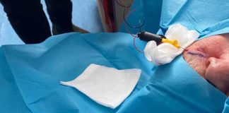 Dolore neuropatico cronico curato in ambulatorio, a Bitonto una nuova tecnica mininvasiva